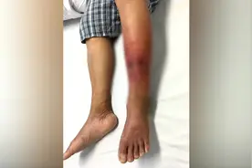 鞋袜湿了一定要换！一男子雨后蹚水不换湿鞋袜，不幸中丹毒