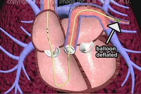 Swan Ganz pulmonary Artery #医学生 #医护日常 #医学英语视频封面