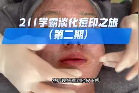 长完痘痘，留下这种红黑印子消不掉那你一定要看看这个视频