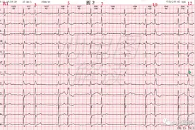 房早伴差传和室早的鉴别、插入性室早诱发的差传、散点图视频封面