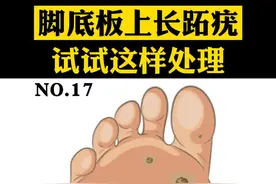 脚底板上长了#跖疣  不用太担心，教你正确处理 #医学科普 #健康 