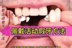 #佩戴 #活动假牙 的方法#假牙