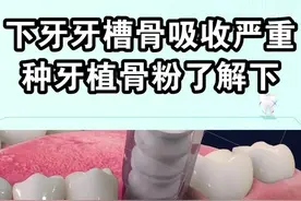 牙槽骨吸收严重的患者需要填充骨粉，那怎么填充呢？一起来看看吧！#郑州 #知识创作人 #dou出新知