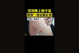 被蚊虫叮咬后起红疹，不想留下黑印这样做#丘疹性荨麻疹 #医学科普 #皮肤 