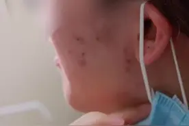 #激光点阵 改善痘印痘坑，效果不错哦！#痘疤视频封面