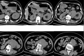 老年女性，发现腹膜后病变，增强CT诊断什么？医生讲解#原创