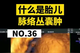 给大家做科普比做手术累多了... 大家咨询太多，没法及时回复请理解。1群，2群已满，需要朋友主页加3群#医学科普 #脉络丛囊肿 视频封面
