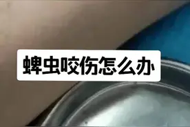 蜱虫别乱取，严重可致命！夏天来临，转发提醒身边的人！