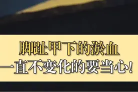 #健康 #科普 脚趾甲的浴血要注意