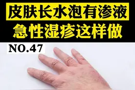 皮肤长水泡有渗液，急性湿疹怎么办#急性湿疹 #医学科普 #健康科普 视频封面