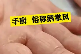 手部粗糙干裂如鹅掌该怎么办？这个视频教你解决。#科普 #涨知识 #冷知识 