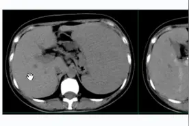 中年女性，反复发热，发现脾脏病变，CT增强诊断什么？#医学科普视频封面