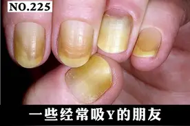 #医学科普经常烟熏手指甲，指甲变得黄黄的，可以这样处理。#健康科普 #戒烟吧 