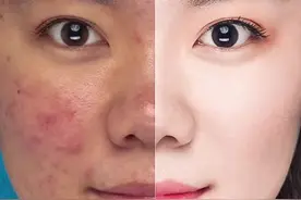 #ps 我最喜欢的痘痘 证件照修图视频封面