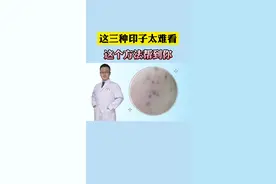 身上这三种黑印，处理起来很简单#医学科普#皮肤#痘印#黑印 