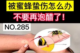被蜜蜂蜇伤，科学处理很重要，别再泡醋了！#蜜蜂 #医学科普 #健康科普 #科普 #涨知识 