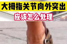 大拇指关节向外突出，穿鞋子还贼丑，看完视频就知道该怎么办了！#拇外翻 #脚 #夏天