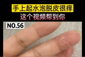手上起水泡，脱皮很痒，手部#湿疹 应该怎么办，这个视频帮到你#科普视频封面