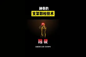 神奇的支架取栓技术#颈动脉支架 视频封面