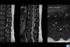 腰椎MRI病例分享：终丝脂肪沉积如何诊断？专科医生讲解#健康科普