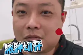 智齿发炎，必要时切开排脓才好得快#拔智齿 #口腔科普 