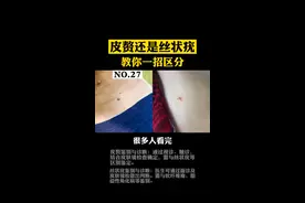 #皮赘 还是#丝状疣？一直分不清，教你一招正确区分！#医学科普 