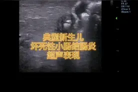 新生儿坏死性小肠结肠炎超声表现。#医学科普 #医学影像 #超声学习 #好书推荐 @抖音短视频 