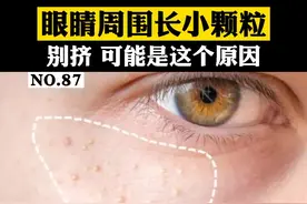 眼睛周围有一些小颗粒，摸起来硬硬的，别再挤了#科普 #脂肪粒 #化妆 