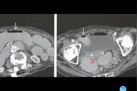 老年女性，腹痛、腹胀入院，CT诊断什么疾病？医生讲解#健康科普视频封面