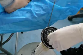 液氮冷冻很疼吗？ #医学科普 #液氮冷冻 #病毒疣 #跖疣 