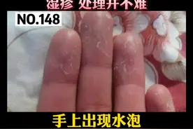 很多#妈妈们会出现这种情况，是因为长期做家务，接触刺激物，手总是沾水而导致的，但她们自己却不会重视，我们要多给她们一些关心#科普 #湿疹 