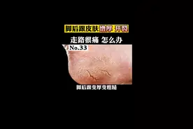 脚后跟变厚变粗糙还开裂可能是脚气，#角化型足癣 你可以这样做#脚气 #医学科普 