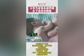 父母为省钱未做四维生下连体双胞胎。#新生儿 #双胞胎 #刚出生的宝宝 @抖音短视频 @DOU+上热门视频封面