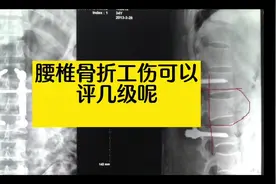 工伤腰椎骨折工伤可以评几级#工伤，#广东工伤赔偿标准视频封面