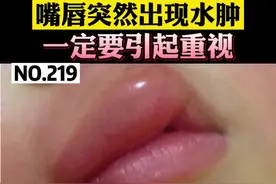 睡一觉起来，嘴唇突然肿了，需要注意咯！特别是得过荨麻疹的朋友#荨麻疹 #皮肤 #嘴唇 