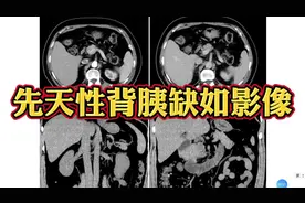 胰腺发育异常：先天性背胰缺如影像表现，初学者必看！视频封面