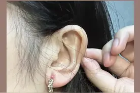 打完耳洞要注意会长出肉疙瘩，我又翻车了，继续反面教材#硬核健康科普行动#打耳洞#瘢痕