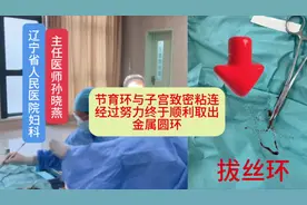 节育环与子宫致密粘连，节育环拔丝，顺利取出🙏#节育环 #拔丝视频封面