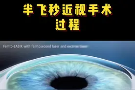 #半飞秒近视手术 过程演示。#近视手术 #近视