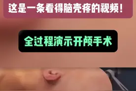 这是一条看得脑壳疼的视频！ #开颅手术动画 #医学科普 #动画演示 #硬核健康科普行动