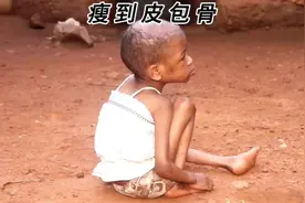 你敢相信眼前这个小男孩十岁了吗？他的体重只有40斤不到。