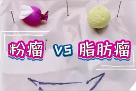 「粉瘤」和「脂肪瘤」 粉瘤和脂肪瘤都是皮下良性包块，粉瘤又称皮脂腺囊肿，囊像皮球，内有豆渣样物质，挤破会化脓。脂肪瘤没有囊壁，似脂肪组织，大部分触之柔软，取出容易。#硬核健康科普行动 #粉瘤 #脂肪瘤 #挤粉瘤 #沈阳市第一人民医院医疗美容科 @DOU+小助手