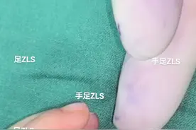 复拇指，1型，对称型。 治疗方案：手指拼合。20240219 #复拇指 #多指 #拇指发育不良 #并指