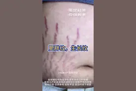 生长纹是这样的 #硬核健康科普行动