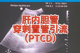 #胆道梗阻#急性胆管炎#彩超引导下经皮肝内胆管穿刺置管引流视频封面