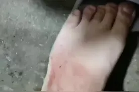 当自己不知道什么咬伤，可能延误治疗，错过最佳时间或者浪费很多钱，而且不一定有效果，延误治疗可能截肢，好人一生平安#蛇类科普#眼镜蛇咬伤视频封面