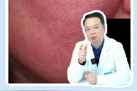 玫瑰痤疮仅靠照光就能快速见效？黄红光治玫瑰的底层逻辑你知道吗？ #在抖音pick你的健康搭子 #解锁春日健康清单 #抖出健康知识宝藏 #皮肤科医生谢红付 #医疗健康创作训练营视频封面