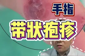 手指 带状疱疹 #带状疱疹 #风湿病 #抖出健康知识宝藏 视频封面