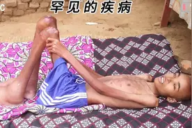 这个男孩堪称（皮包骨）是这个世界上最瘦的男孩视频封面