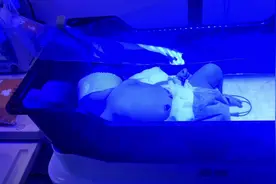 搜了好多说这个溶血性黄疸有的还是挺严重的